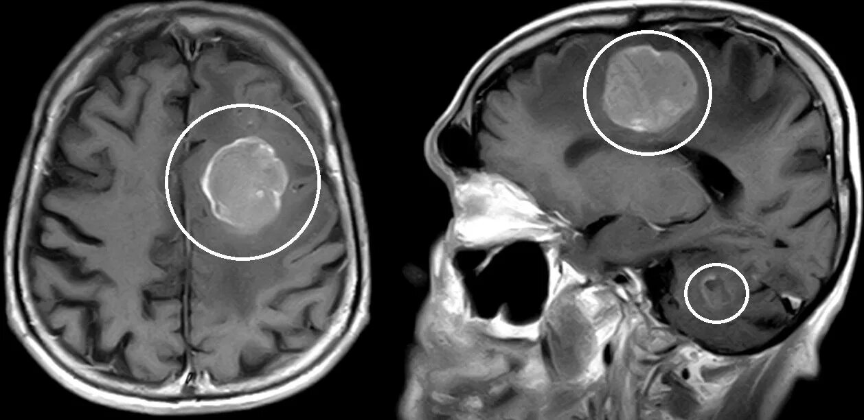 опухоль мозга кота