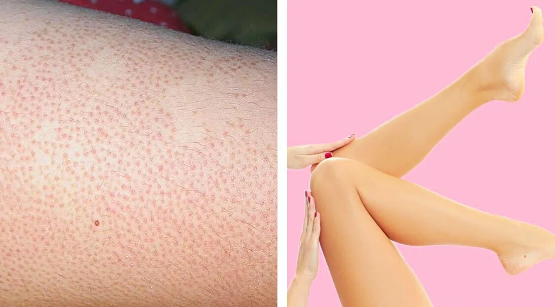 Keratosis pilaris (фолликулярный гиперкератоз).