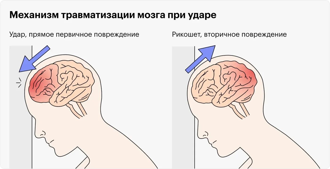 Упала затылком что делать. Сотрясение головы и головного мозга. Если сильно ударился головой. Сотрясение и ушиб головного мозга.