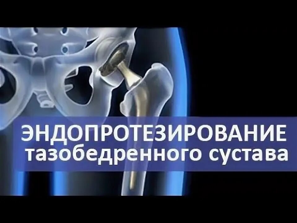 Барнаул суставы операция. Эндопротезирование тазобедренного сустава операция. Эндопротезирование тазобедренного сустава операция видео. Операция по замене тазобедренного сустава видео. Квантовое исцеление тазобедренного сустава.