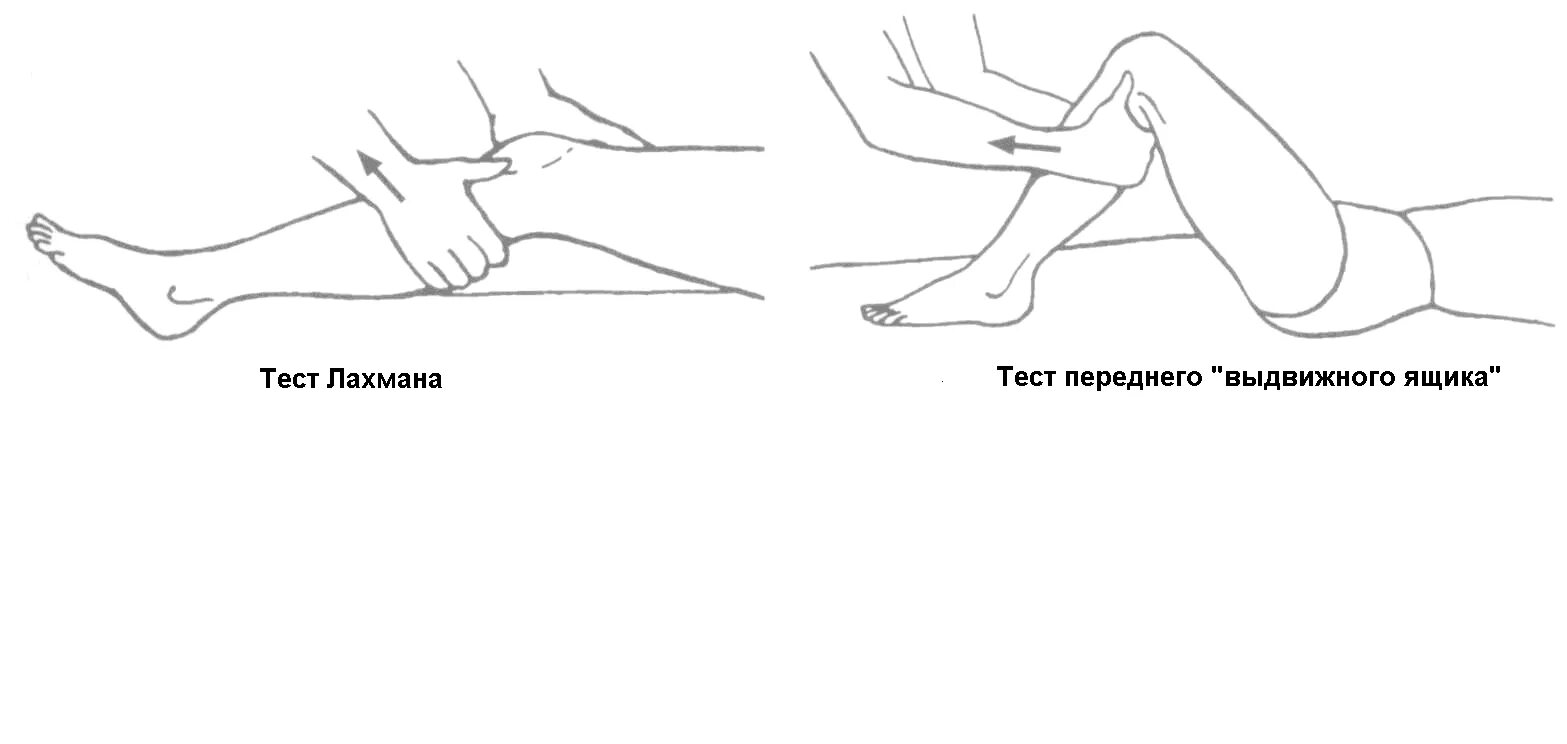 Симптом переднего выдвижного ящика. Синдром переднего выдвижного ящика коленного сустава. Тест Лахмана коленного сустава. Тест выдвижного ящика коленного. Тесты на коленный сустав