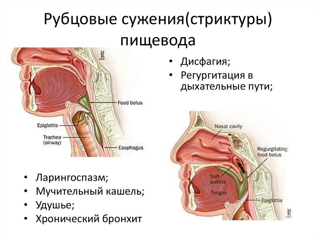 Рубцовые сужения пищевода