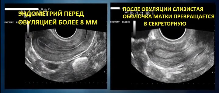 Какой эндометрий при месячных. Матка после овуляции УЗИ. Трехслойный эндометрий.