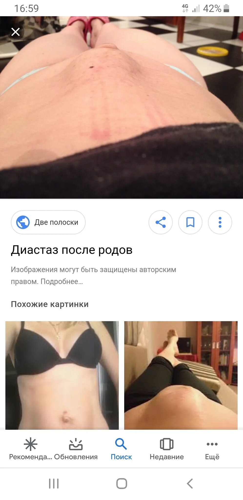 Как выглядит диастаз после родов Диастаз: что это, почему возникает и как с ним бороться
