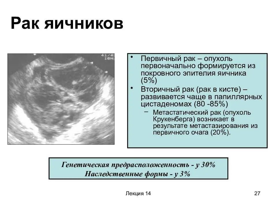 Доброкачественная опухоль яичника УЗИ. Доброкачественные опухоли яичников УЗИ. Объемные образования яичников. Рак после удаления яичников