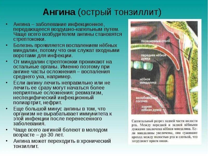 Лакунарная бактериальная ангина. Острые и хронические воспаления миндалин. Болит носоглотка что делать
