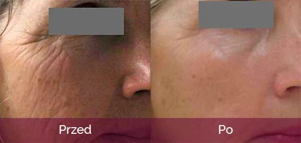 Фракционная шлифовка рубцов постакне. Дермапен реабилитация. Дермапен до и после. Дермапен до и после. Dermapen дермапен до и после.