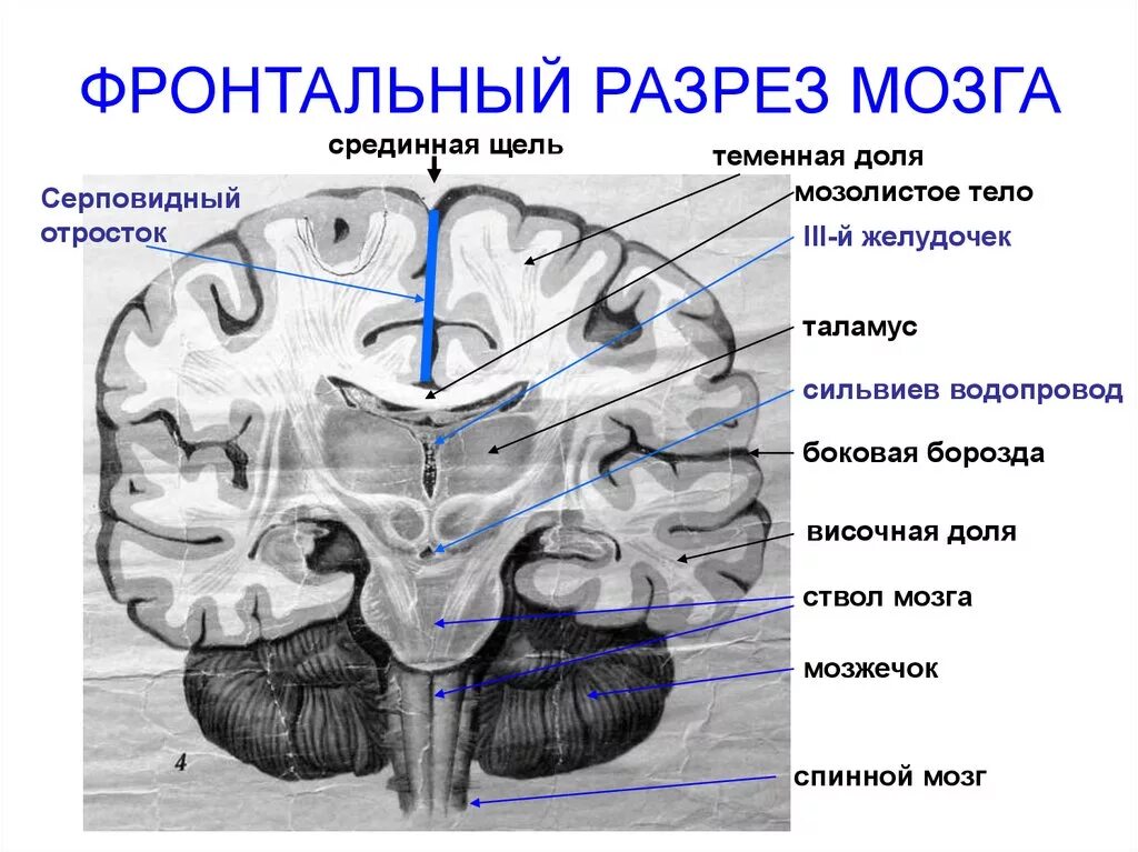 Строение головного мозга фронтальный срез. Фронтальный разрез мозга анатомия. Поперечный срез головного мозга мозга. Третий желудочек головного мозга анатомия. Длинные отростки головного мозга