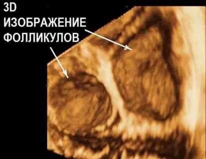 Фолликул 17 мм форум