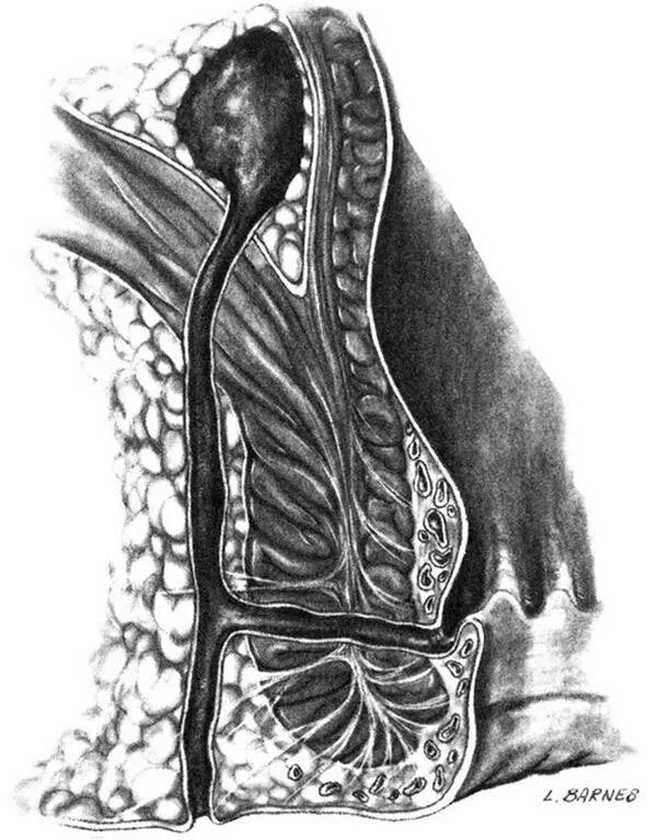 Парапроктит параректальный свищ. Транссфинктерный парапроктит свищ. Парапроктит и свищ прямой кишки. Хронический парапроктит.