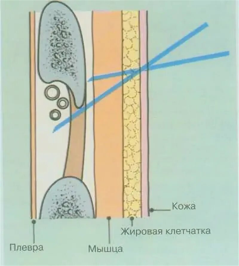 Межреберная блокада. Межреберная паравертебральная блокада. Паравертебральная блокада межреберных нервов. Техника новокаиновой блокады межреберных нервов. Межреберная новокаиновая блокада.