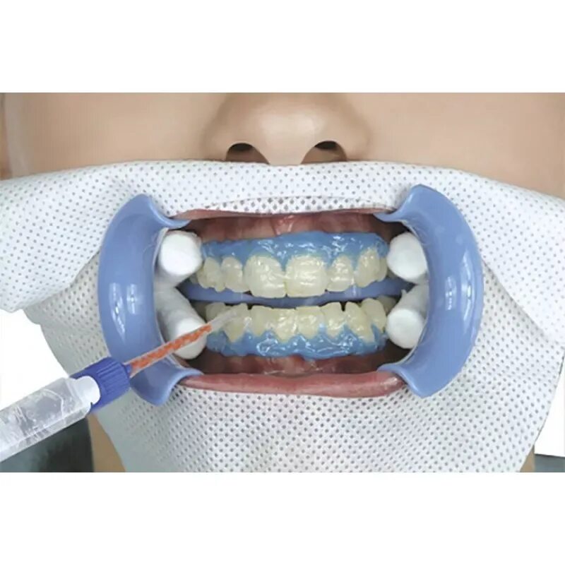 Зубы после 30. Отбеливание Бейонд. Распорка стоматологическая. Распорки для рта в стоматологии. Распорка для зубов в стоматологии для детей.