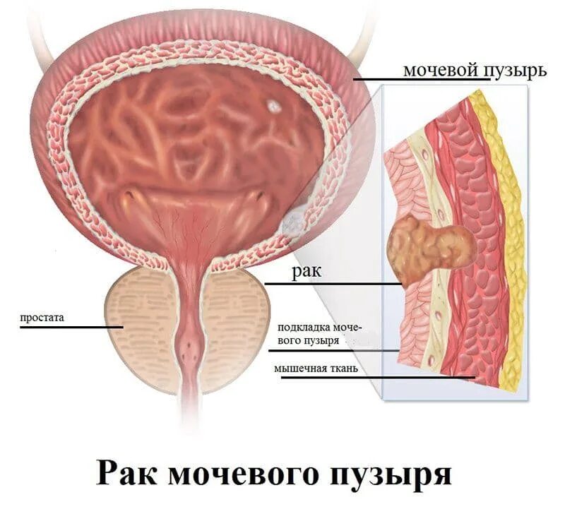 Лечение рака мочевого пузыря у мужчин. Мочевой пузырь. Опухоль мочевого пузыря. Опухоли мочевогоп пузыря. Онкология мочевого пузыря.