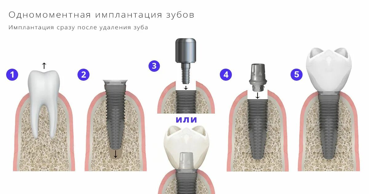 Имплантация 1 этап. Одномоментная имплантация зубов. этапы имплантации зубов. схема установки импланта зуба.