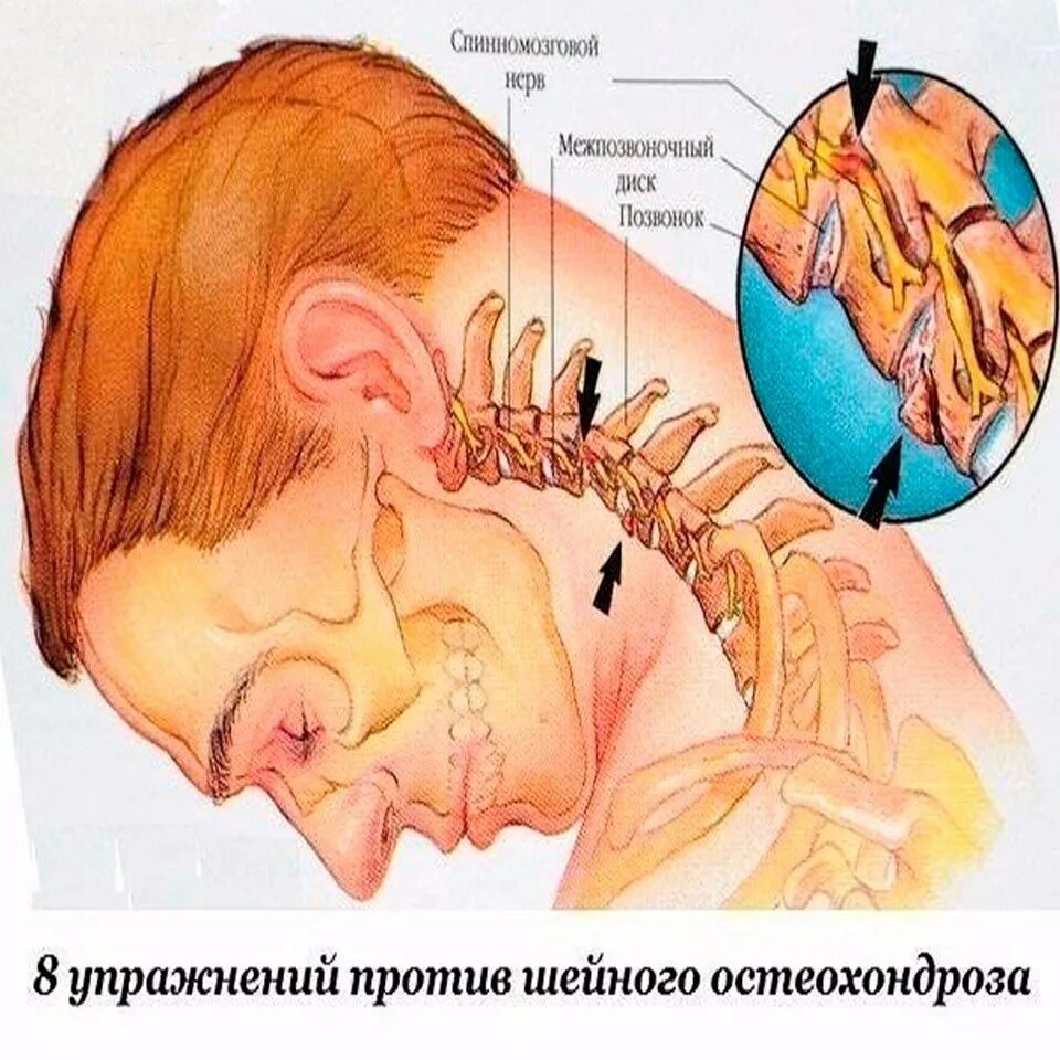 Голова стучит сильно. Шум в ушах и голове. Если звон в голове что это такое. Шум в голове шейном остеохондрозе.