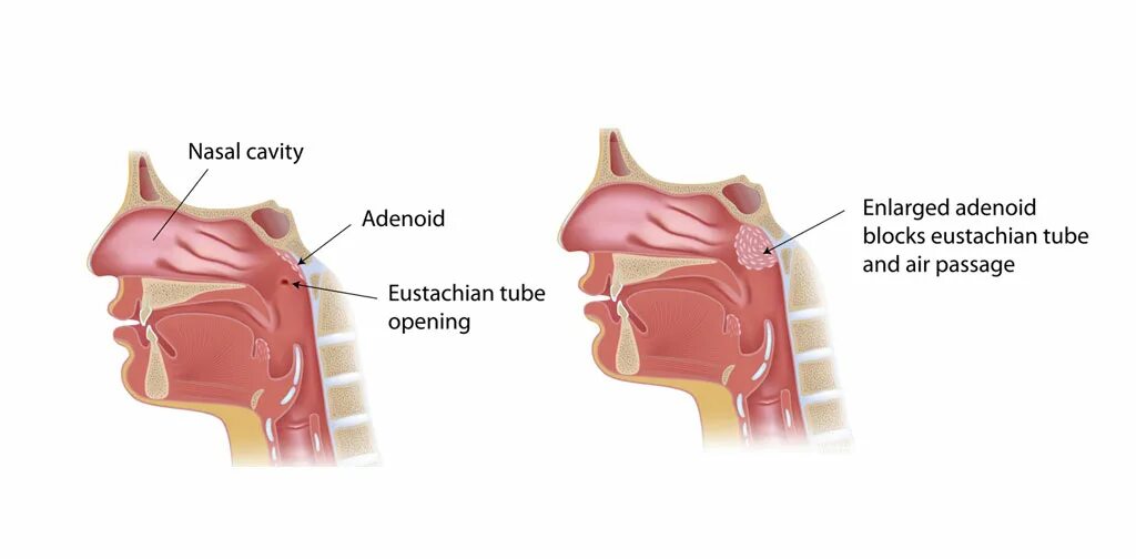 Аденоиды признаки. Анатомия ЛОР органов аденоиды. Миндалины аденоиды анатомия. Анатомия носоглотки аденоиды. Глоточная миндалина аденоиды.