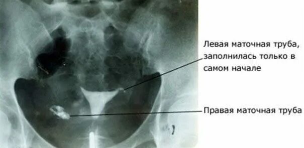 Сколько труб у женщины. ГСГ снимки маточных труб непроходимость. Гистеросальпингография непроходимость маточных труб. Методы проходимости маточных труб. Непроходимость маточных труб на снимке.