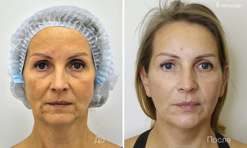 Массаж лица до и после. Lpg массаж лица до и после. Lpg массаж лица результат. Lpg лица до и после. Массаж лица до и после.