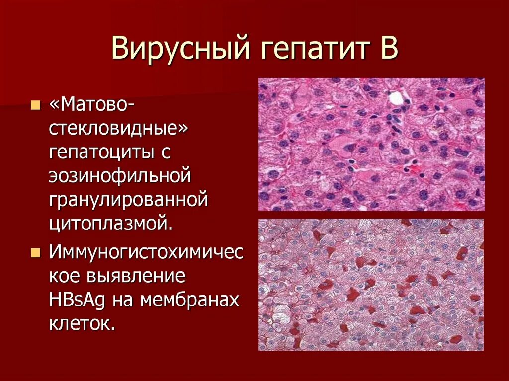 Изменение клеток печени. Вирусный гепатит печени микропрепарат. Гепатит гистология микропрепарат. Матово стекловидные гепатоциты. Гепатит с гистология печени.