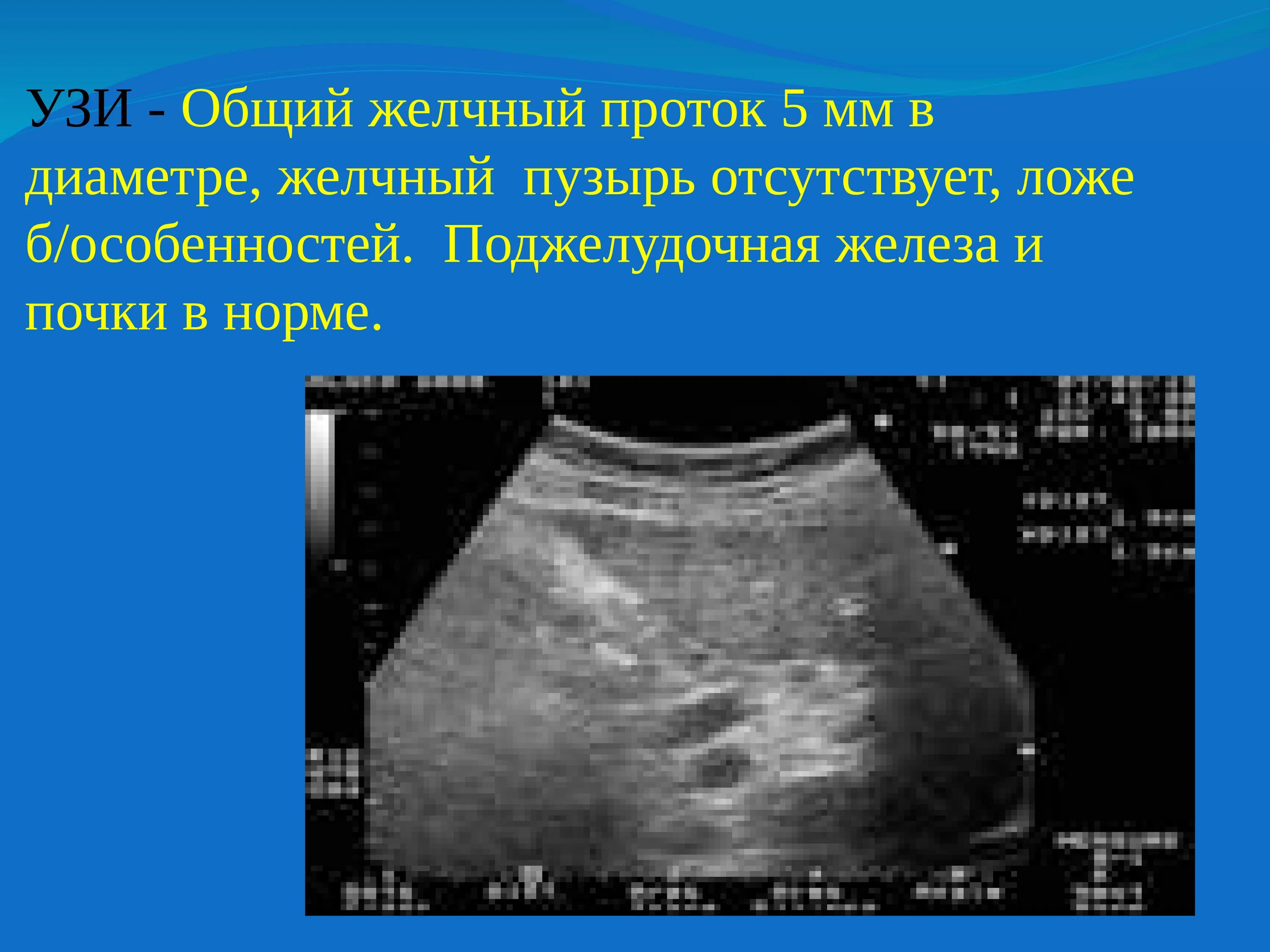 УЗИ ложа желчного пузыря. Желчный проток на УЗИ норма. Диаметр желчных протоков в норме УЗИ. Общий желчный проток Ази.