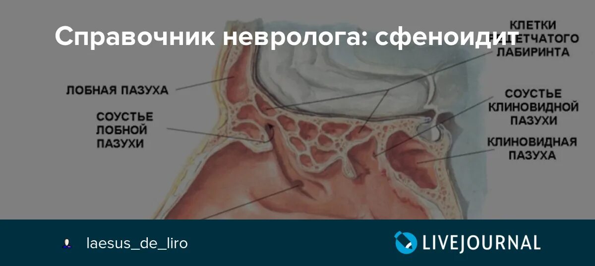 Гемисинусит, сфеноидит. Сфеноидит на кт. Воспаление слизистой клиновидной пазухи.