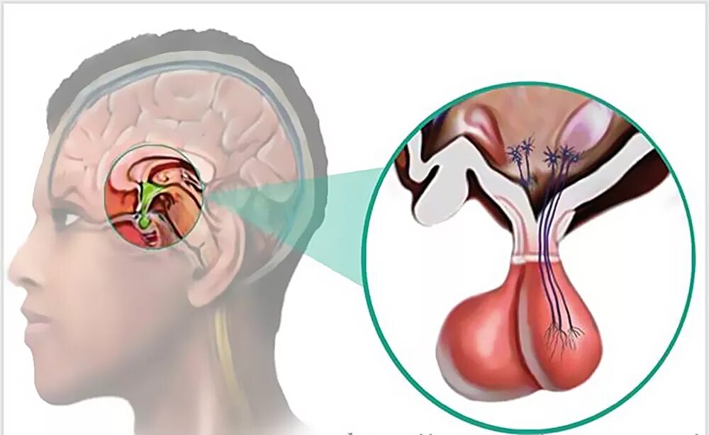 Гипофиз у мужчин. Гипофиз что это такое, микроаденома гипофиза. Опухоль головного мозга аденома гипофиза. Пролактинома на мрт головного мозга. Аденома гипофиза пролактинома.