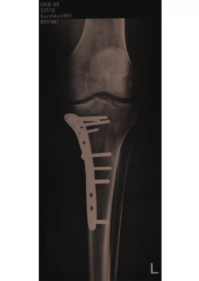 Перелом мыщелка большеберцовой кости. Остеосинтез мыщелков большеберцовой. Остеосинтез мыщелка берцовой кости. Перелом мыщелка берцовой кости. Остеосинтез мыщелка