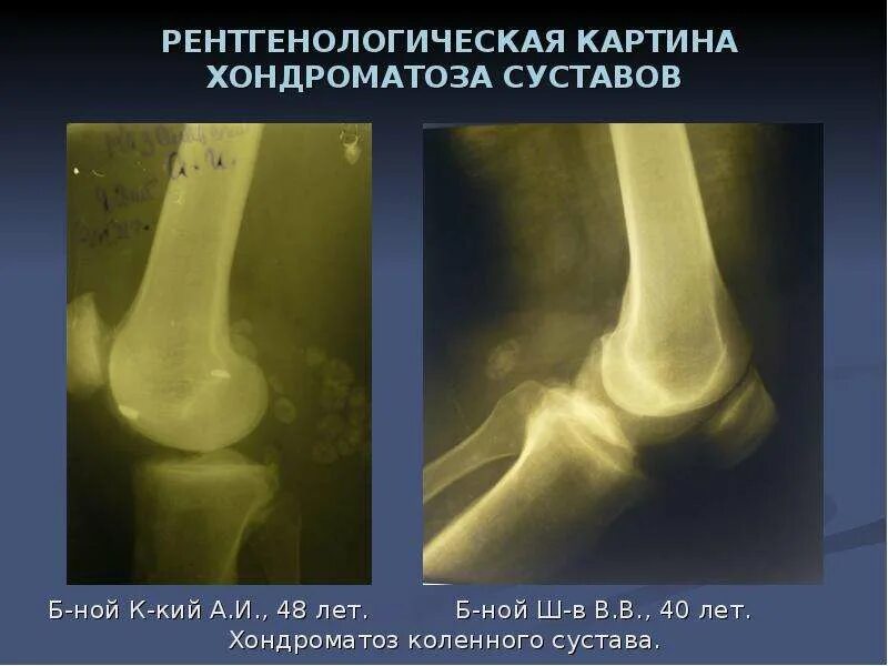 Хондроматоз локтевого сустава рентген. Хондроматоз локтевого сустава рентген. Синовиальный хондроматоз коленного сустава рентген. Хондроматоз надколенника. Хондроматоз плечевого сустава рентген.