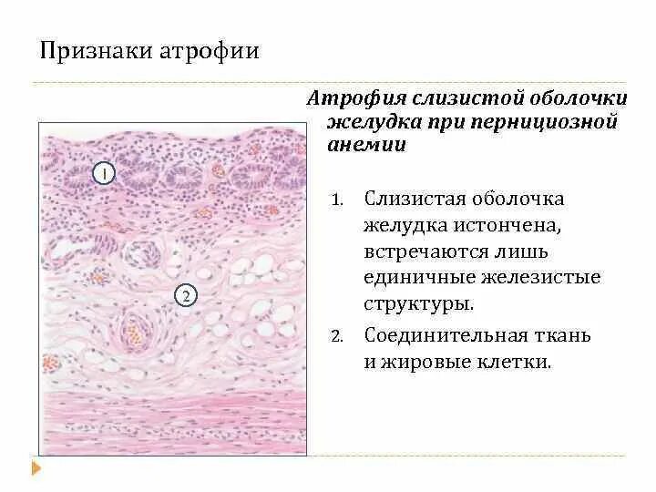 Атрофия слизистой желудка микропрепарат. Микропрепарат атрофия слизистой оболочки желудка. Атрофия слизистой желудка при пернициозной анемии. Атрофический гастрит патанатомия. Слизистая атрофична