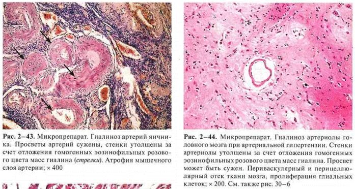 Гипофункция паращитовидной железы. Паращитовидная аденома форум. Аденома паращитовидной железы микропрепарат. Паращитовидная аденома форум. Паращитовидные железы на узи.