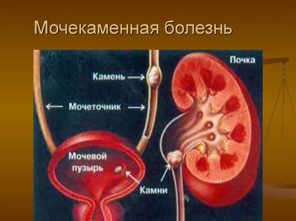 Мочекаменная болезнь мочеточника