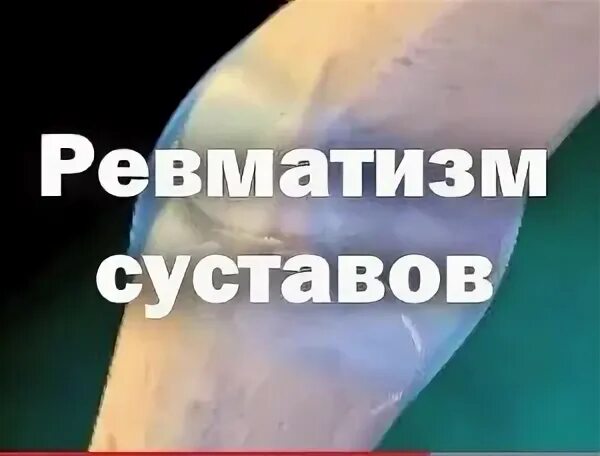 Ревматизм суставов симптомы у женщин после 50