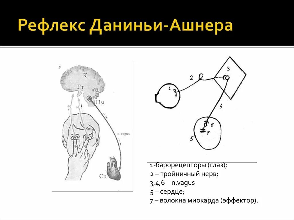 Изобразить схему рефлекторной дуги. Схема рефлекторной дуги рефлекса Данини Ашнера. Рефлекс Данини Ашнера физиология. Рефлекс Данини Ашнера рефлекторная дуга. Схема дуги рефлекса Даньини-Ашнера.