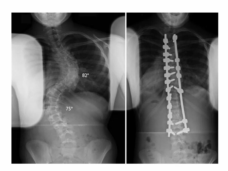 Операция на сколиоз 3 степени. Транспедикулярная фиксация th11-l2. Операция позвоночник форум. Операция на сколиоз 3 степени. Транспедикулярная фиксация позвоночника l5-s1.