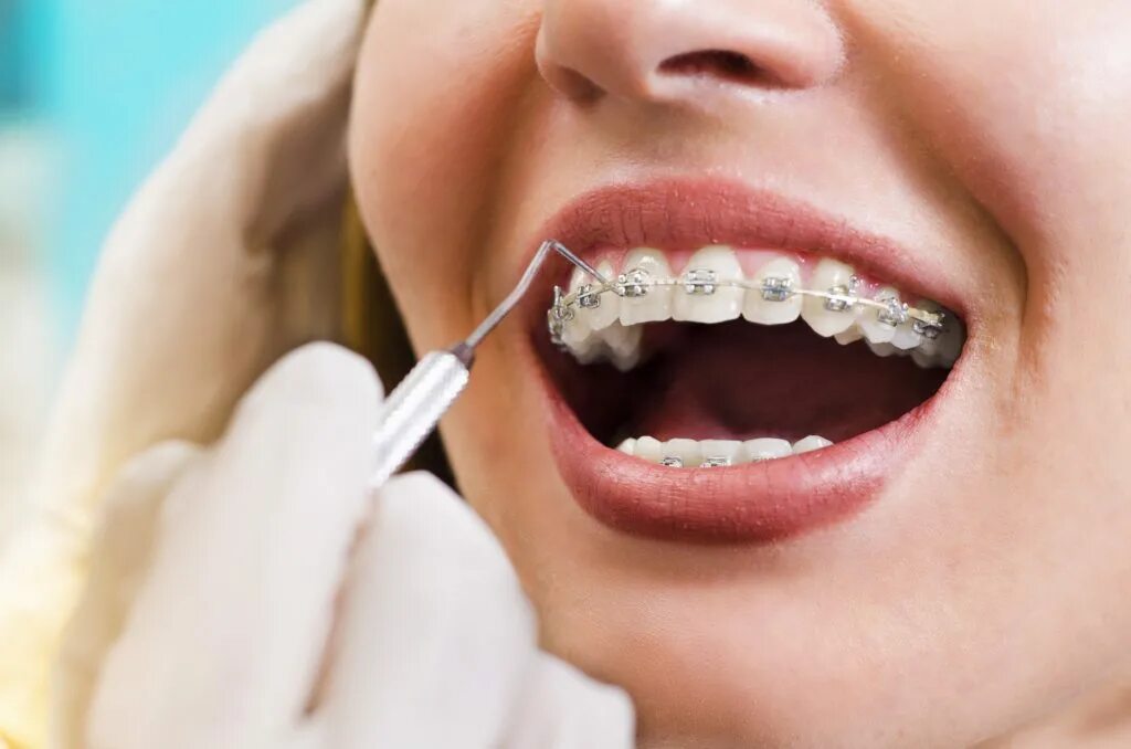 Брекеты. Стоматология брекеты. Ортодонтия в стоматологии.