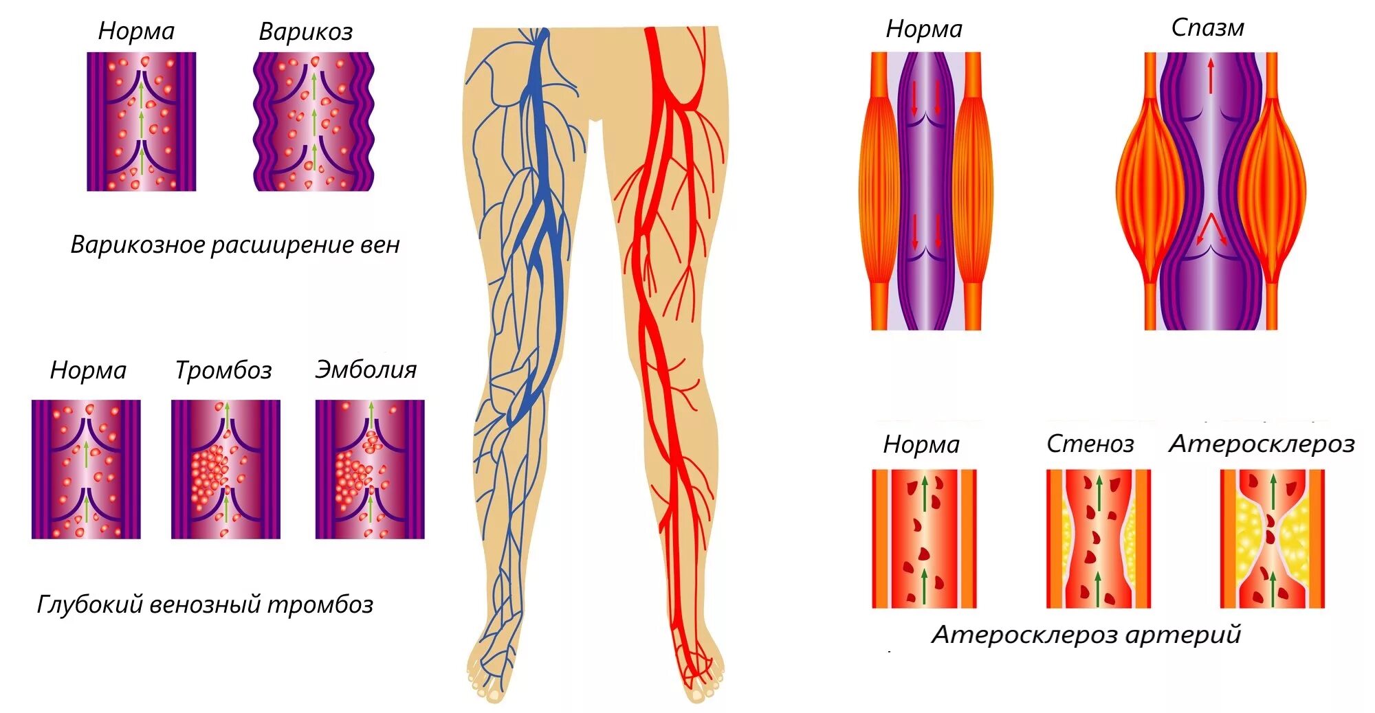 Ангиопластика сосудов нижних конечностей. Варикозное расширение вен нижних конечностей. Варикозное расширение глубоких вен. Тромбоз сосудов нижних конечностей. Тромб норма