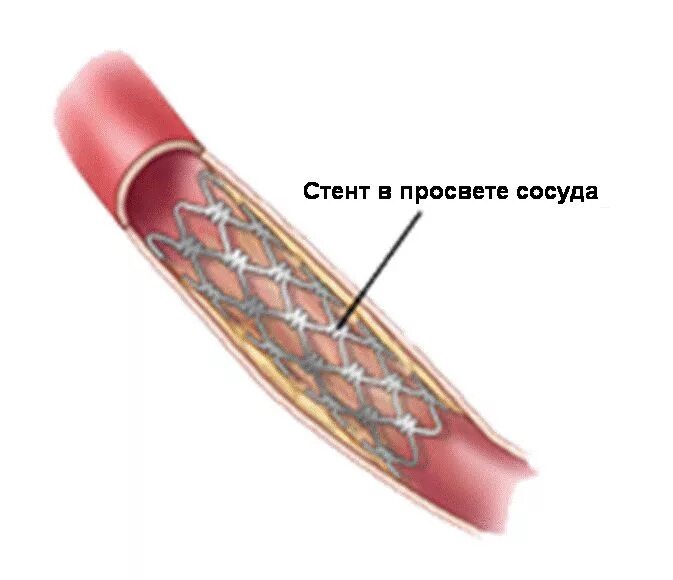 Как ставят стент