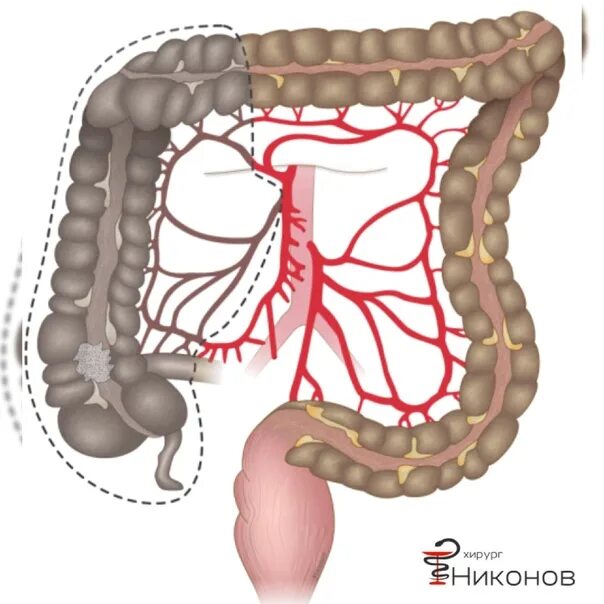 Правосторонняя гемиколэктомия. Левосторонняя гемиколэктомия анастомоз. Левосторонняя гемиколэктомия техника. Операция левосторонняя гемиколэктомия. Колэктомия это