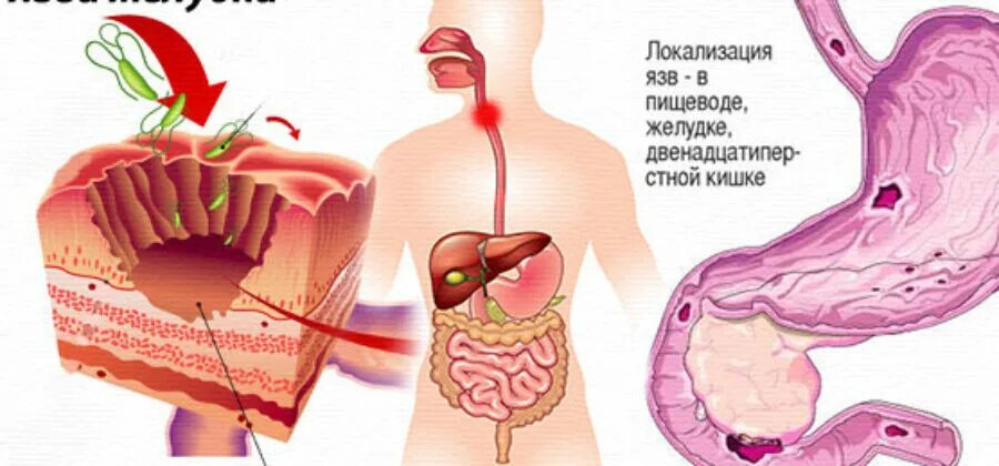 Локализация пищевода. Язвенная болезнь желудка локализация.