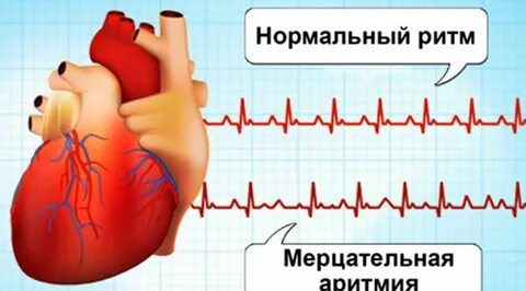Лечение мерцательной аритмии сердца отзывы