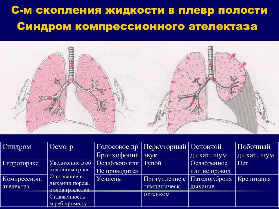 100мл жидкости в плевральной полости. Легкие и плевральная полость. Плевральная полость легких. Компрессионный ателектаз легкого