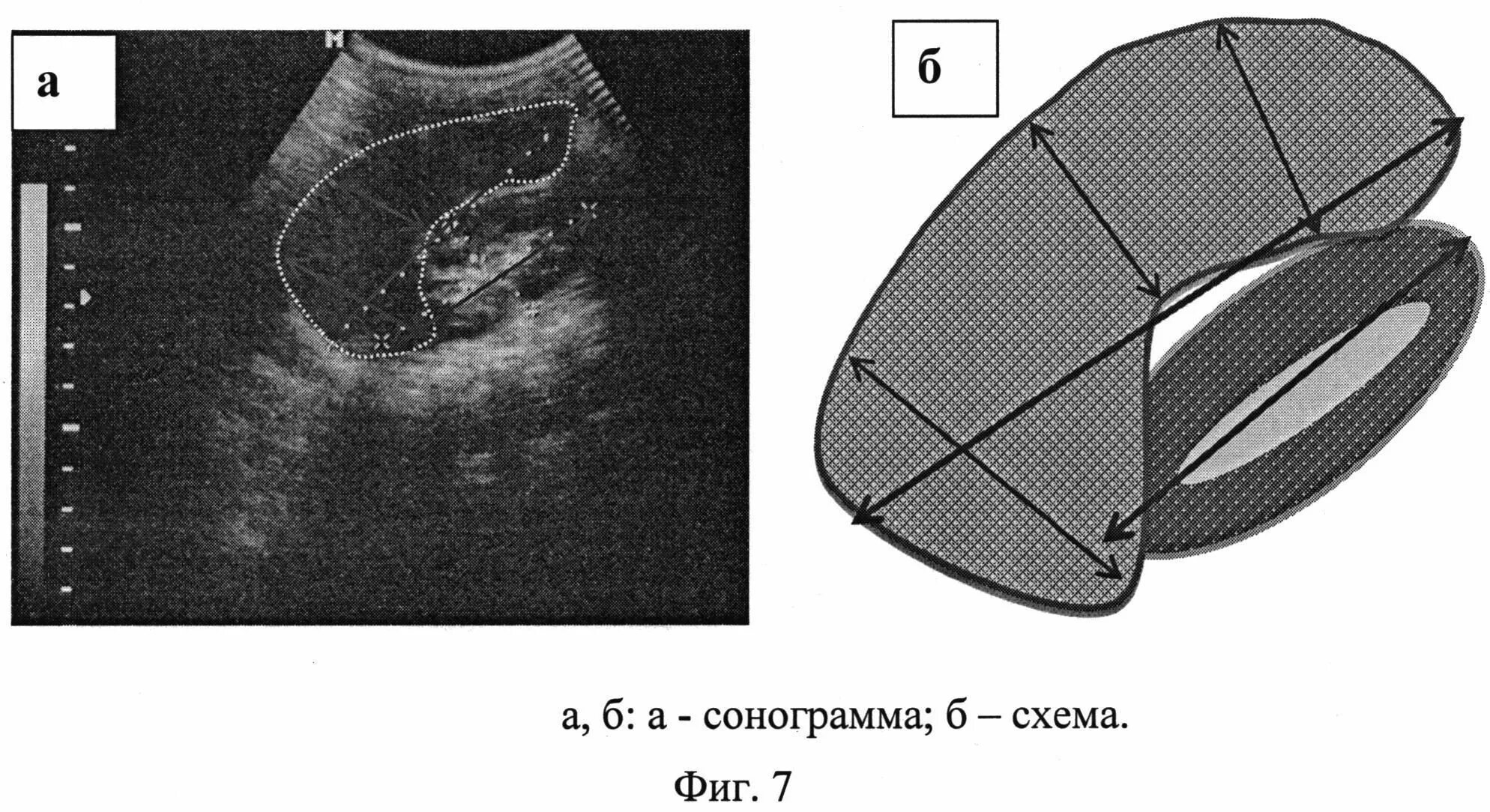 Диффузные изменения селезенки. Туберкулез селезенки на узи. печень при туберкулёзе на узи. туберкулез печени и селезенки.