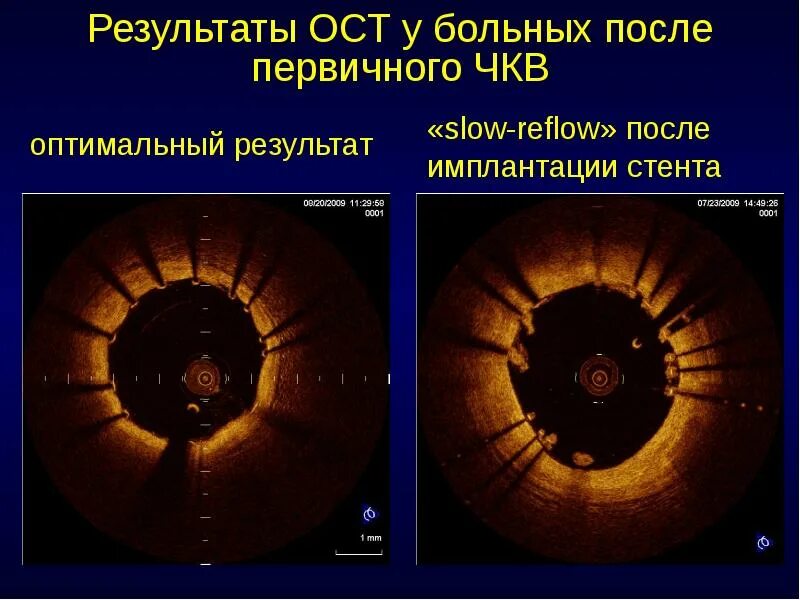 No reflow феномен. Slow reflow феномен. синдром no reflow. феномен no reflow патогенез.