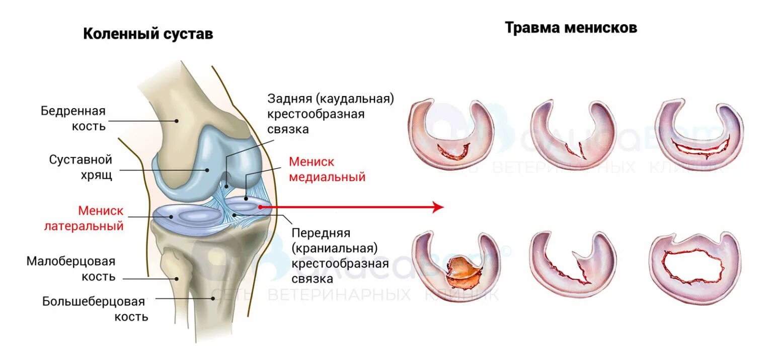 Разрыв мениска заднего рога признаки. Механизм повреждения мениска колена. Задний Рог медиального мениска анатомия. Разрыв внутреннего мениска коленного. Разрыв мениска коленного сустава снимок.