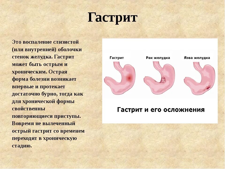 Проект заболевания органов пищеварения 8 класс биология. Заболевание пищеварительной системы гастрит. Острый и хронический гастрит. Болит желудок от витаминов