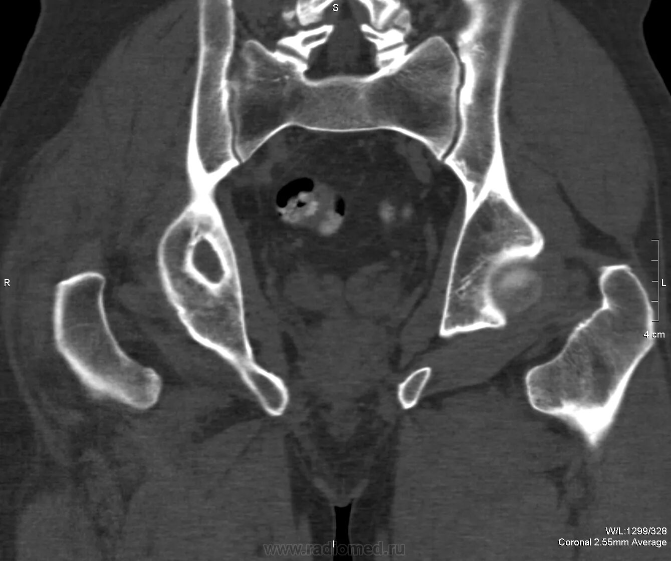 Кт подвздошной кости. Фиброзная дисплазия таза кт. Остеосклероз подвздошной кости. Остеосклероз подвздошной кости кт. Дисплазия костей таза кт.