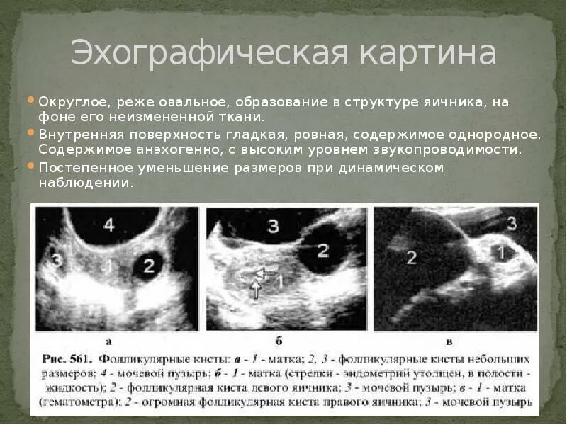 Что такое анэхогенное аваскулярное образование. Анэхогенная структура узи. образование яичника на узи. опухолевидные образования яичников. округлое анэхогенное образование.