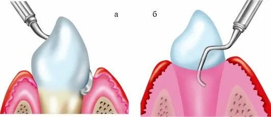 поддесневой зубной камень удаление. поддесневой зубной камень удаление. скейлинг пародонтальных карманов. поддесневой зубной камень удаление. кюретаж пародонтальных карманов.