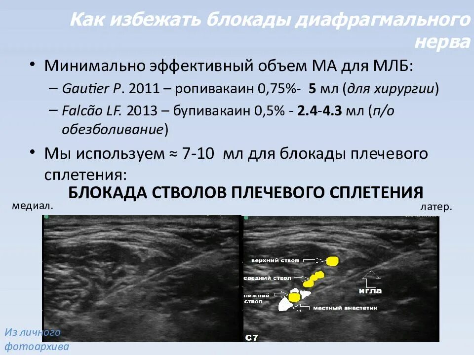 Блокада сплетения. Межлестничная блокада УЗИ. Это блокада нерва под УЗИ контролем. Блокада шейного сплетения под УЗИ. Блокада плечевого сплетения УЗИ.