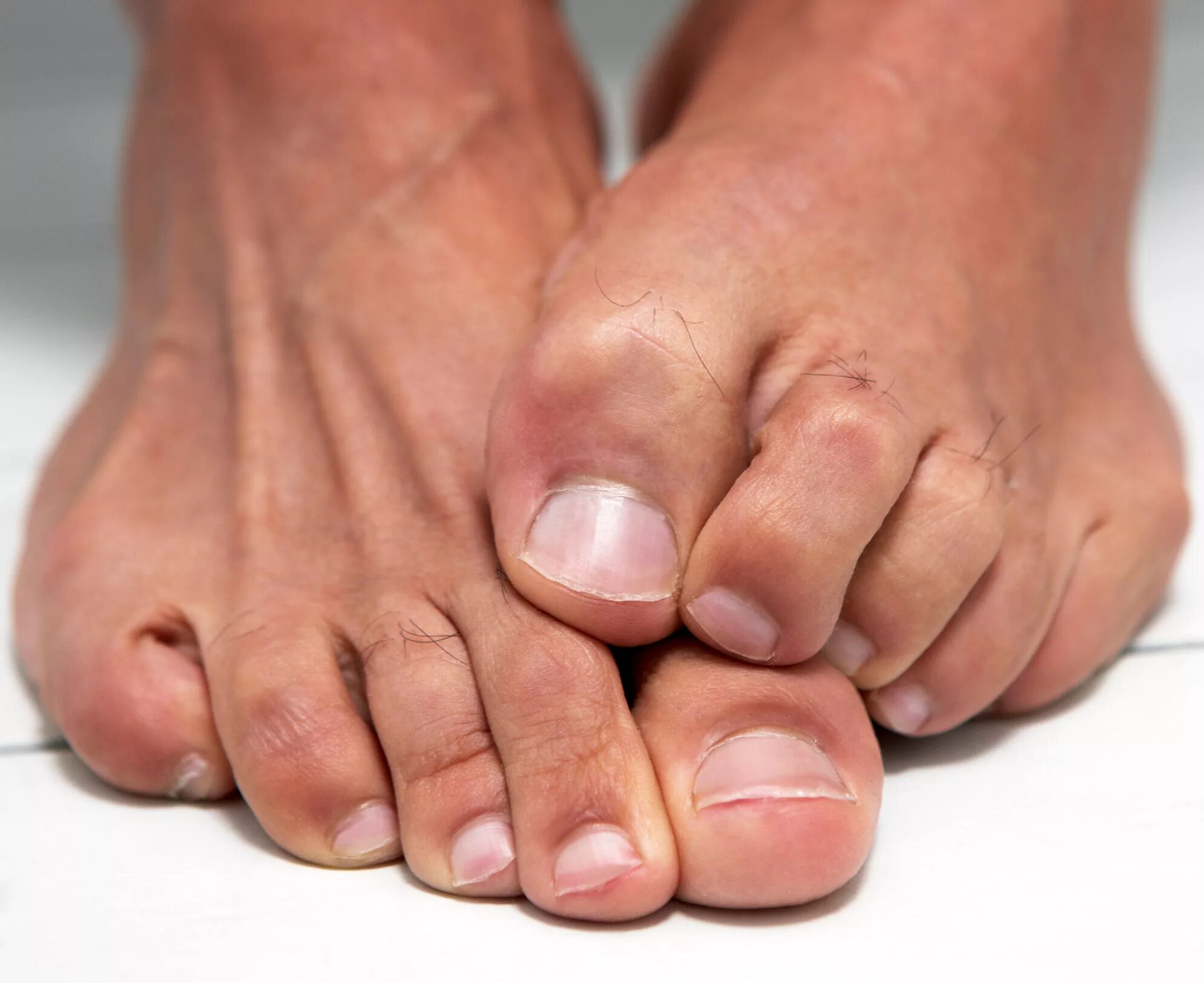 Длинный палец на ноге мужчины. Эпидермофития рубромикоз. Гиперкератотический микоз.